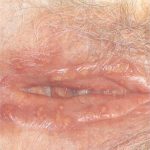 herpes herpes