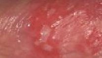 Herpes – Genital Ülser
