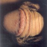 genital ülser genital ülser