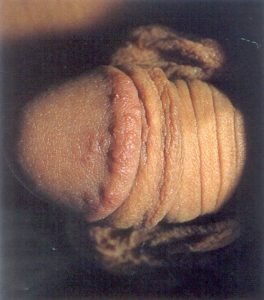 genital ülser
