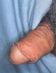 genital ülser - herpes
