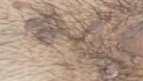 HPV – Genital Siğil – Kondilom