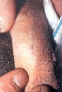 erkeklerde genital siğil, kondilom