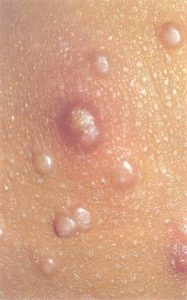 molloscum