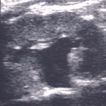 prenatal hidronefroz derece 2 prenatal hidronefroz derece 2