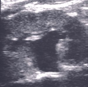 prenatal hidronefroz derece 2