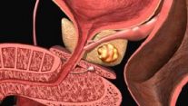 Prostatit – Prostat İltihabı