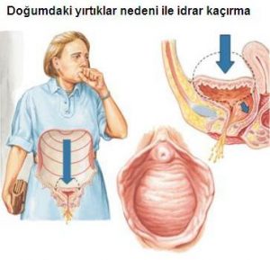 doğumdaki yırtıklar nedeniyle idrar kaçırma